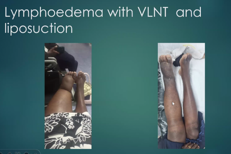 snapshot of the healing progress of a lymhoedema patient who underwent surgery