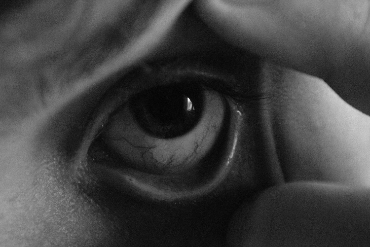 Dry eye