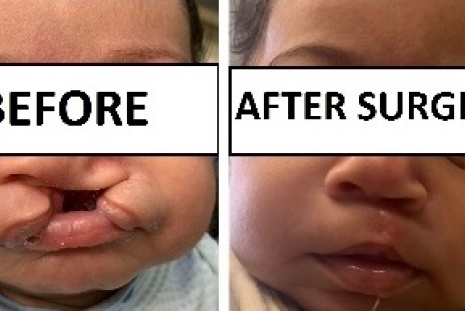 Cleft surgery.