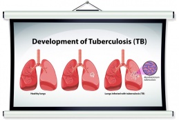Tuberculosis,